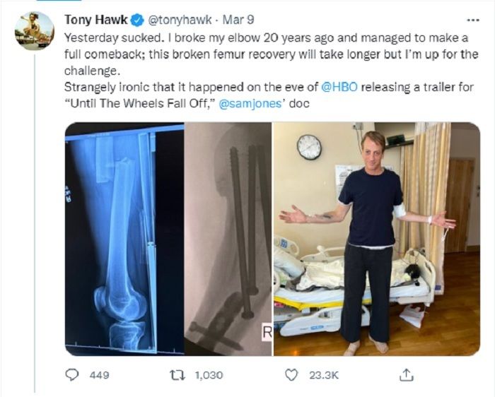 Tony Hawk Broken Femur