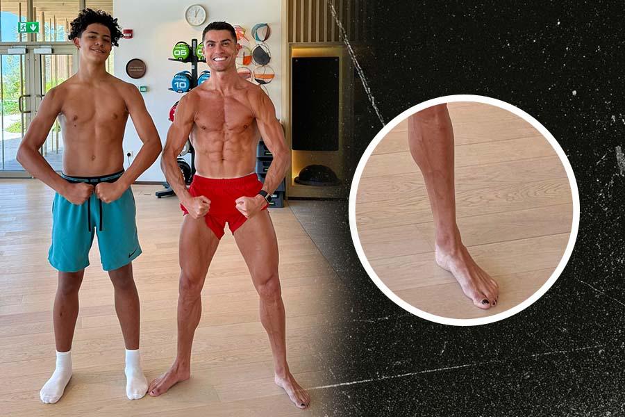 Kuku kaki Cristiano Ronaldo menghitam. (Grafis: Deni Sulaeman/Skor.id).