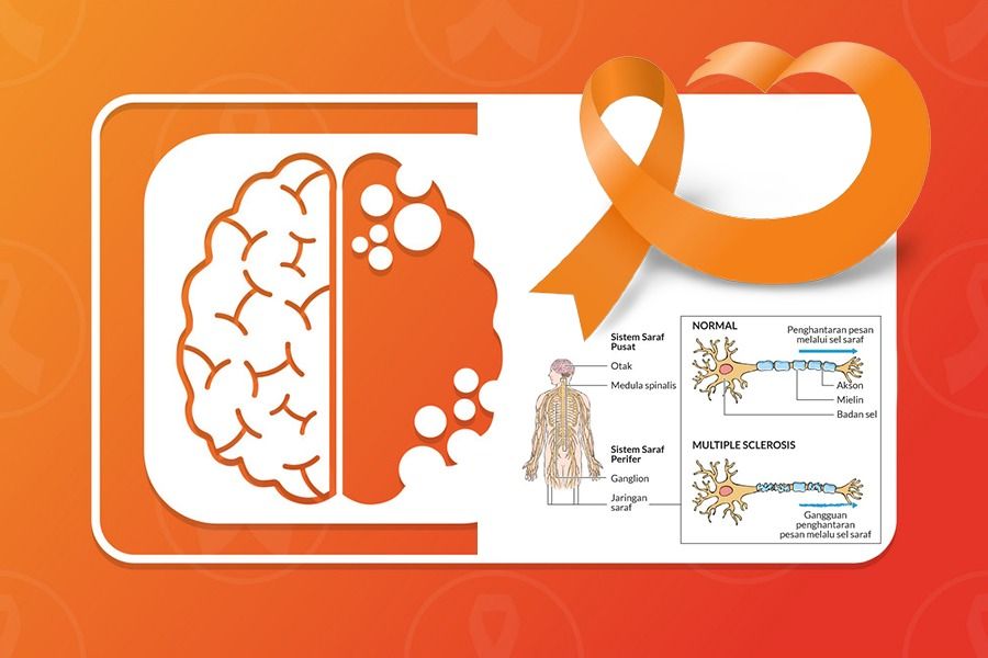 Penyakit multiple sclerosis tidak bisa dianggap remeh karena terkait fungsi saraf. (Rahmat Ari Hidayat/Skor.id)