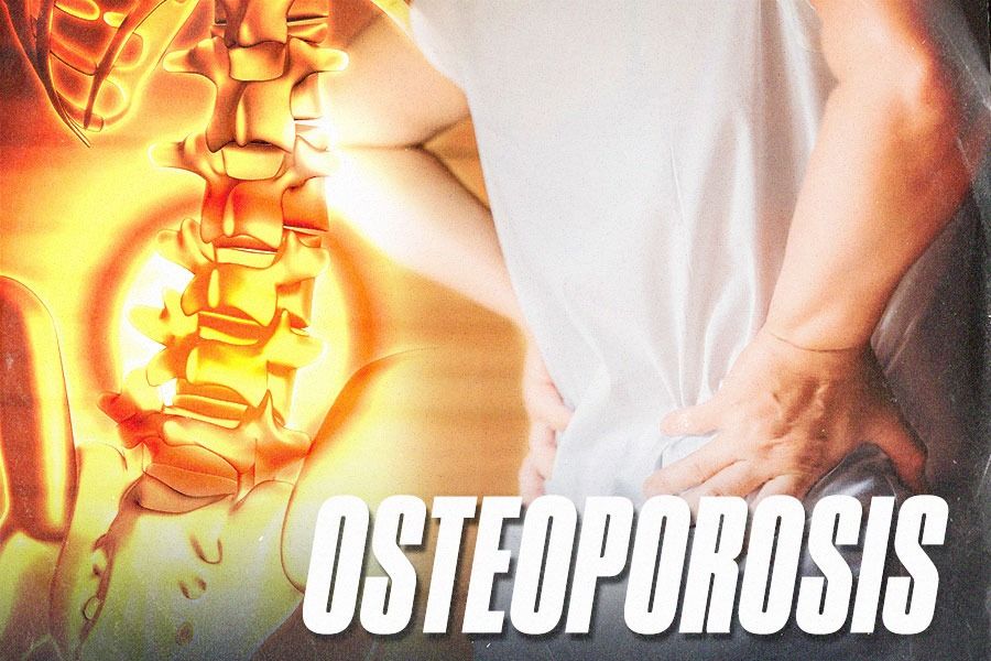 Salah satu penyebab penyakit osteoporosis adalah kurang kalsium (Yusuf/Skor.id).