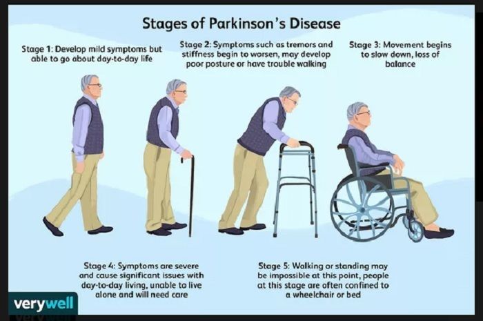 Tahapan yang dialami para penderita Penyakit Parkinson.