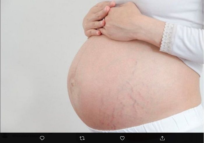 Ilustrasi stretch mark pada wanita hamil.