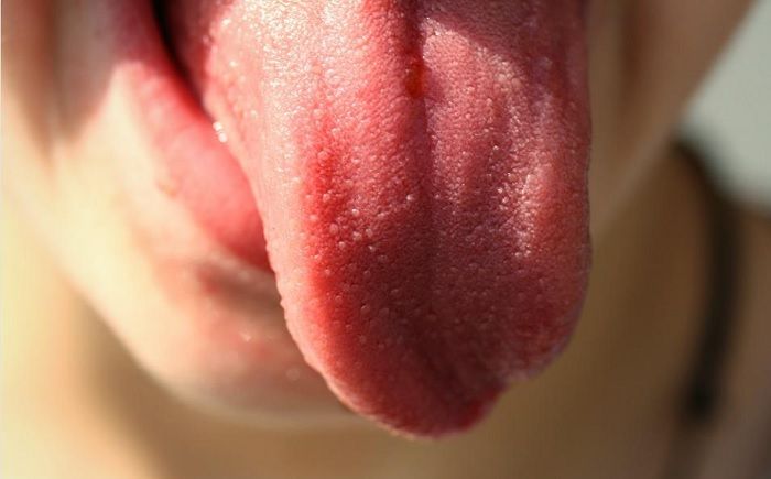 Ilustrasi lidah yang sehat, yakni yang berwarna merah muda, tanpa bintik atau luka.