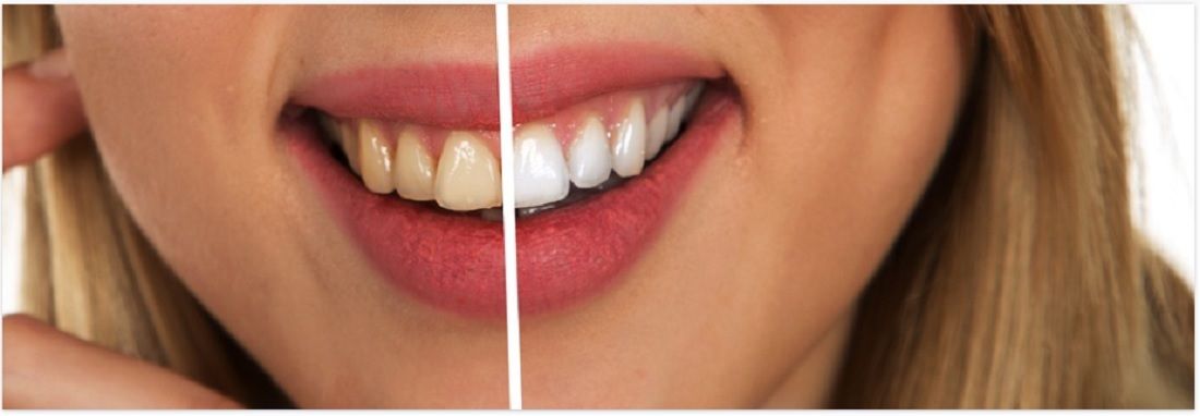 Ilustrasi gigi yang bernoda kuning dan yang berwarna putih sehat.