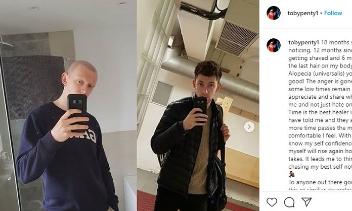 Postingan foto Toby Penty dalam akun Instagram pribadinya, pada 31 Maret 2020, kala membandingkan kondisinya sebelum dan sesudah mengidap alopecia.