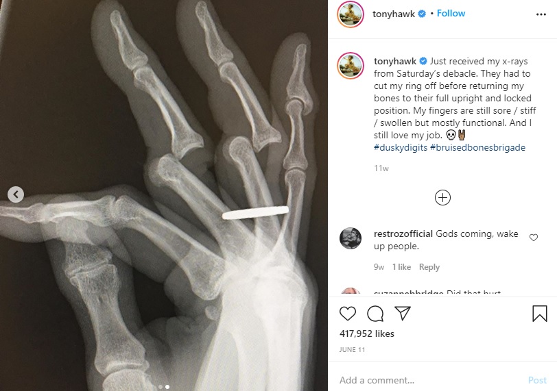 Alami Kecelakaan, Skater Legendaris Tony Hawk Terpaksa Relakan Cincin Kawin
