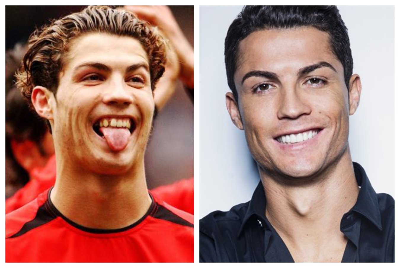 Deretan Tokoh Sepak Bola yang Memperbaiki Giginya, Termasuk Cristiano Ronaldo