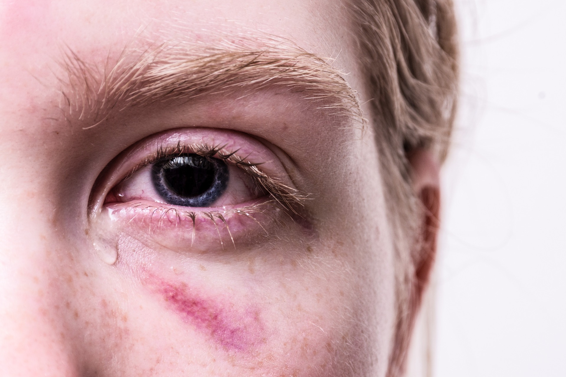 Kenali Gejala pada Mata yang Mengindikasikan Adanya Penyakit dalam Tubuh