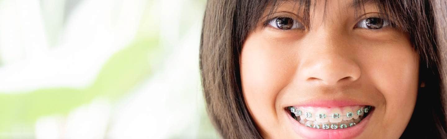 7 Ciri-ciri Anak yang Membutuhkan Kawat Gigi