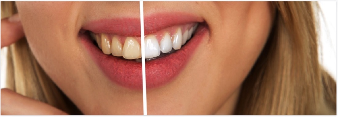 Kenali 5 Bahan Rumahan yang Tak Terbukti Efektif Hilangkan Karang Gigi
